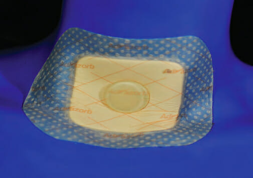 ADVAZORB FIXATION TRACHEOTOMY
