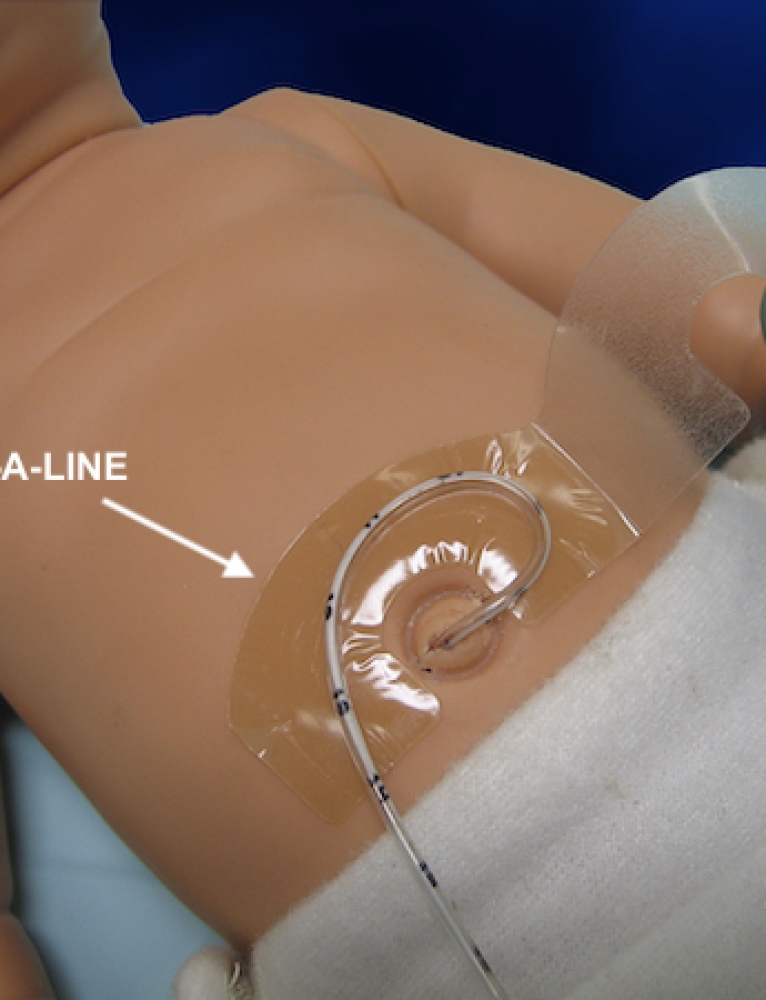 NeoBridge - suporte para cateter umbilical