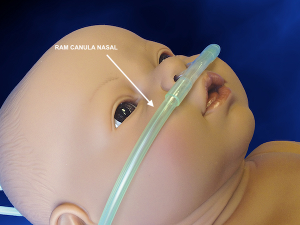 canula-nasal-ram-no-paciente